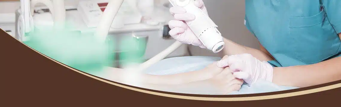 lasersko uklanjanje uraslog nokta