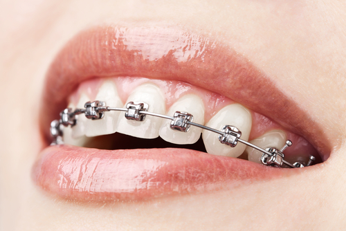 5532-kanakadentalcare0020517040552dentalbraces1